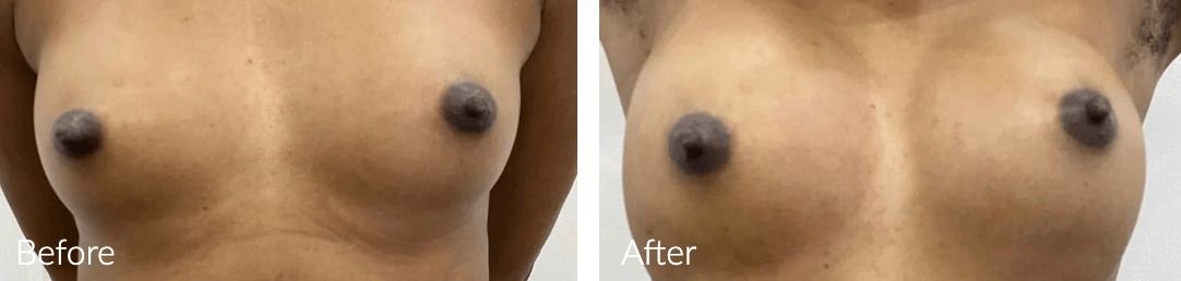 Before and after image of chest enhancement.