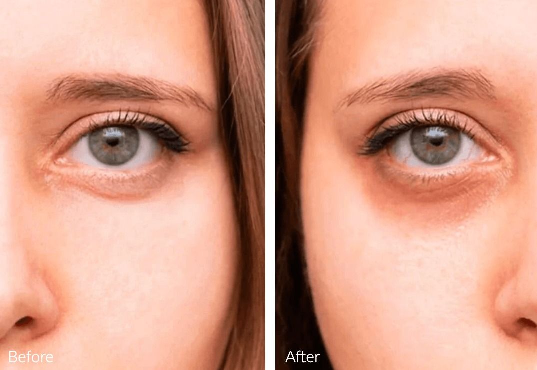 Before and after eye treatment comparison.