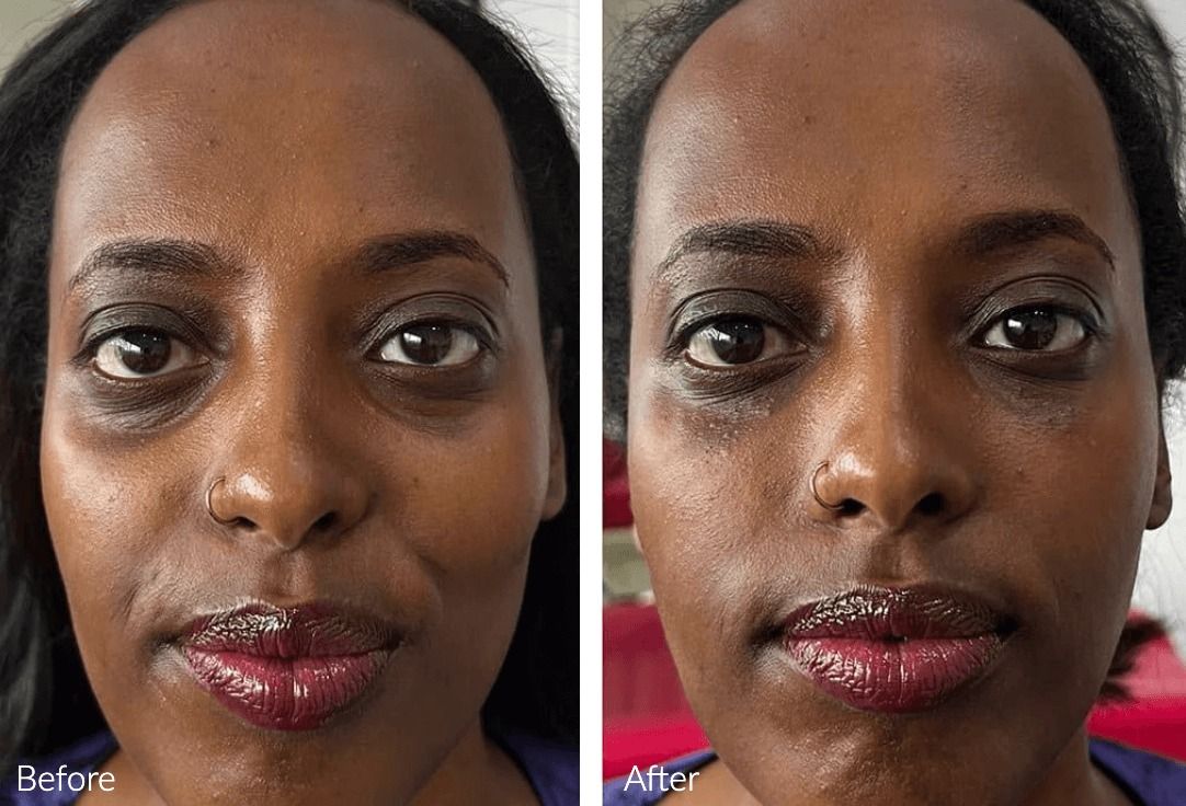 Before and after skin improvement treatment comparison.