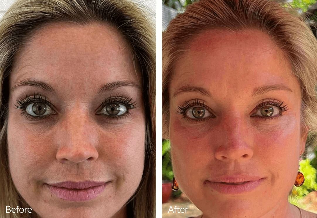 Before and after skin treatment comparison.