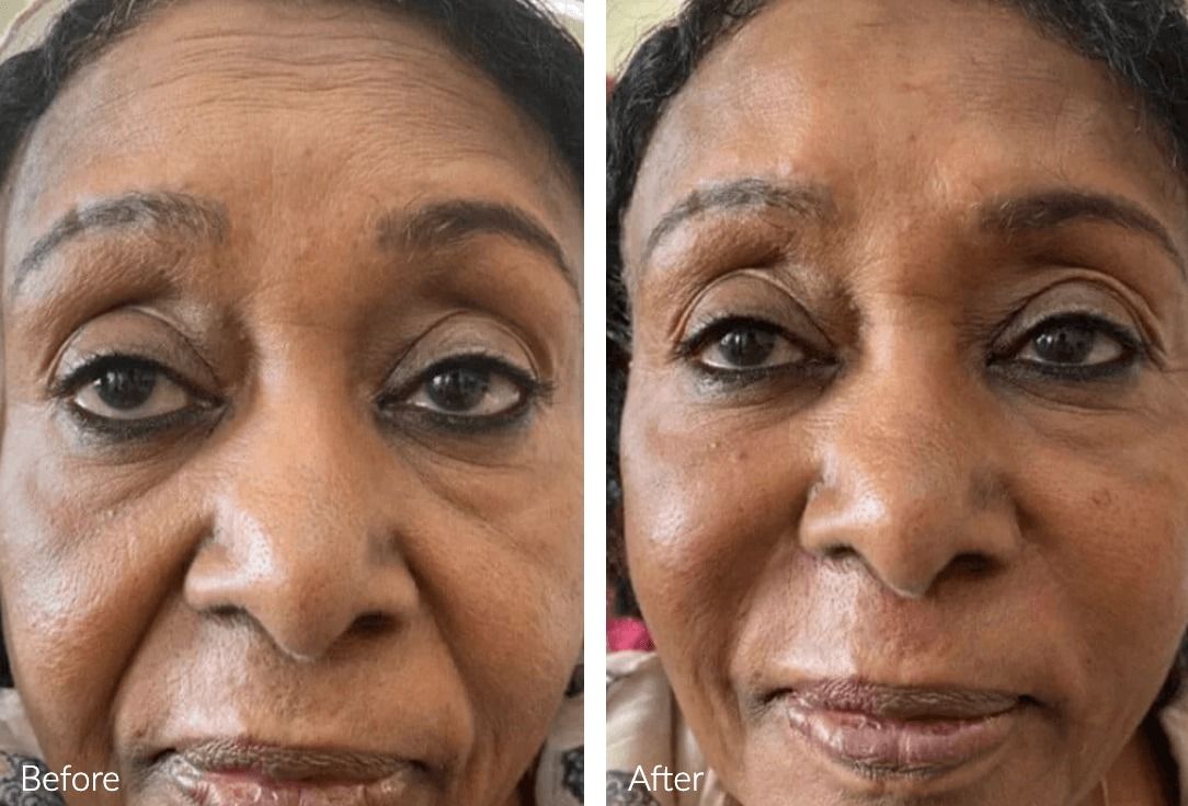 Before and after facial rejuvenation treatment.