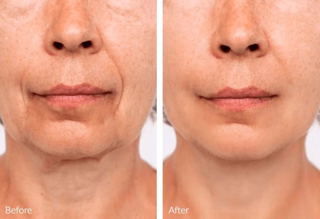 Before and after facial skin treatment comparison.