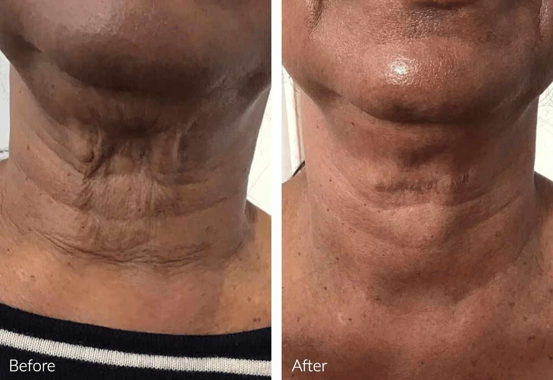 Before and after skin texture improvement comparison.