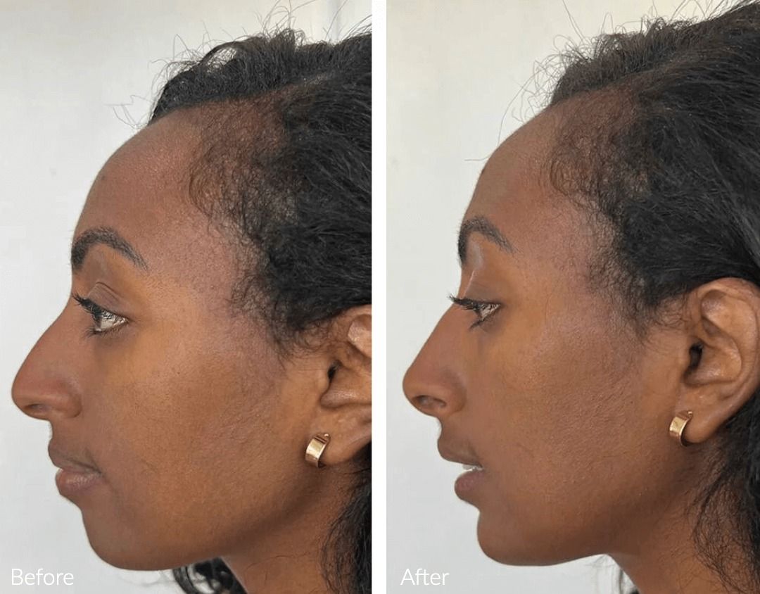 Before and after profile views of a woman.