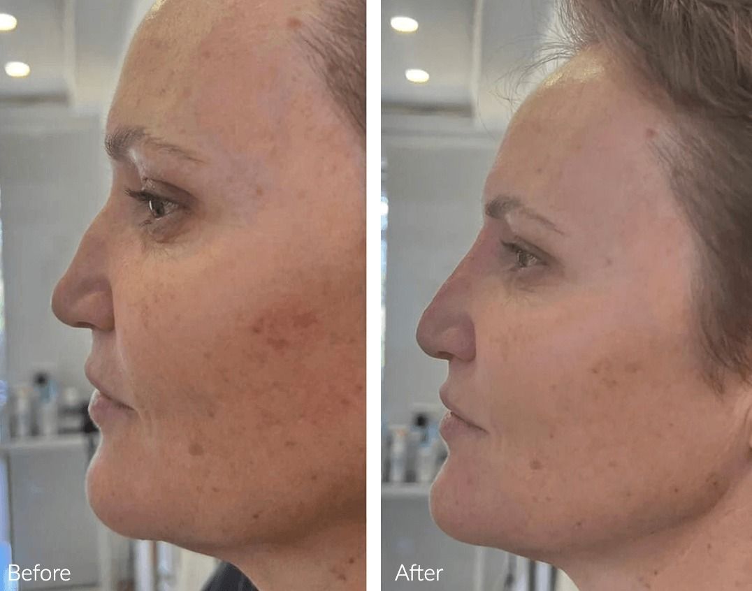 Before and after facial treatment comparison.