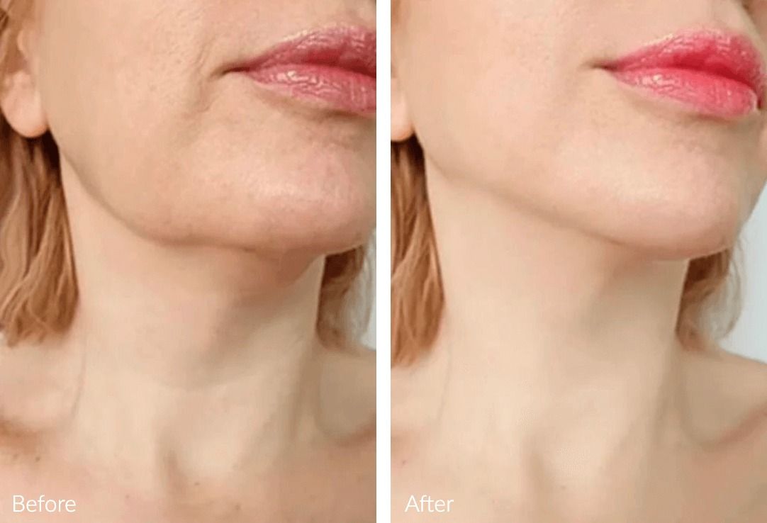 Before and after skin treatment comparison image.