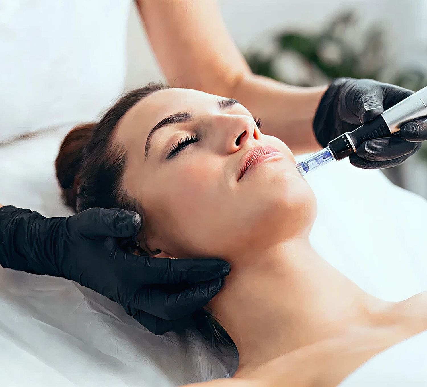 Microneedling treatment on a woman's face at a Nairobi Dermatology Clinic