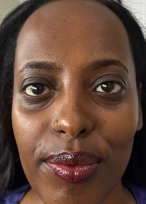 Eyebag Correction Before & After