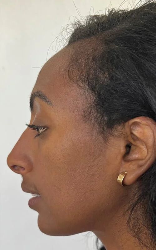 Nose Chin Correction Before & After