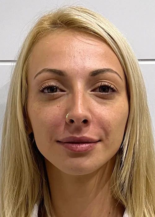 Laughter Lines Before & After