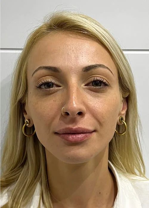 Laughter Lines Before & After