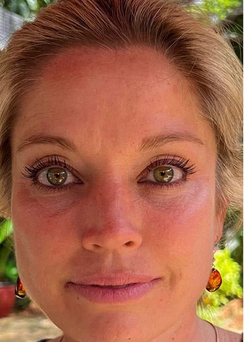 Hydrafacial Before & After