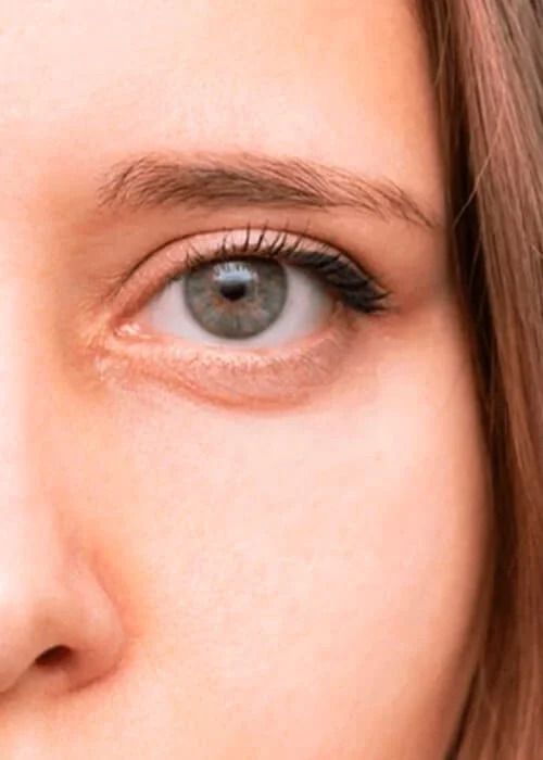 Dark Circle Treatment Before & After