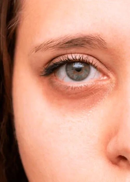 Dark Circle Treatment Before & After