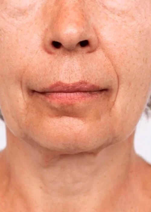 Non Surgical Necklift Before & After