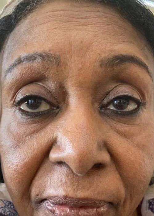 Liquid Facelift Before & After