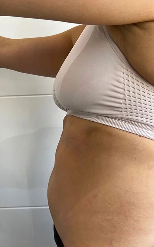 Coolsculpting Before & After