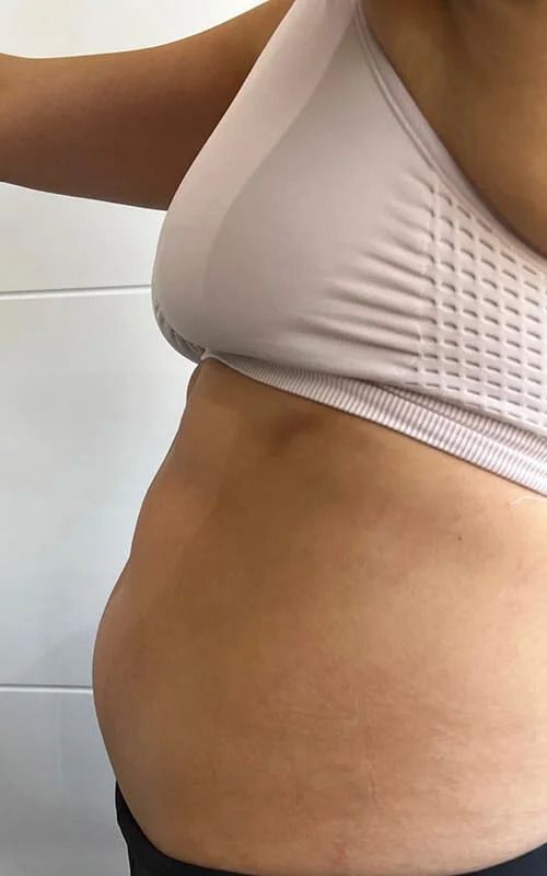 Coolsculpting Before & After