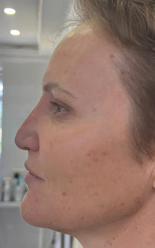 Nose Job Before & After