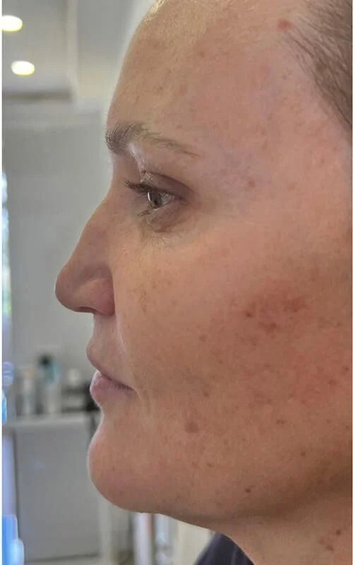 Nose Job Before & After