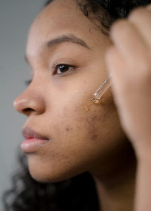A Guide to Acne Solutions