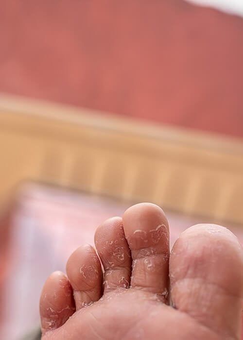 Athlete’s Foot Treatment