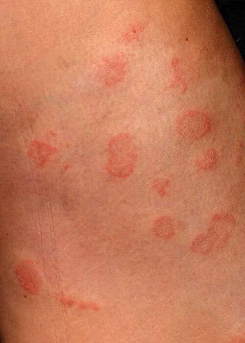Body Fungal Infections Treatment