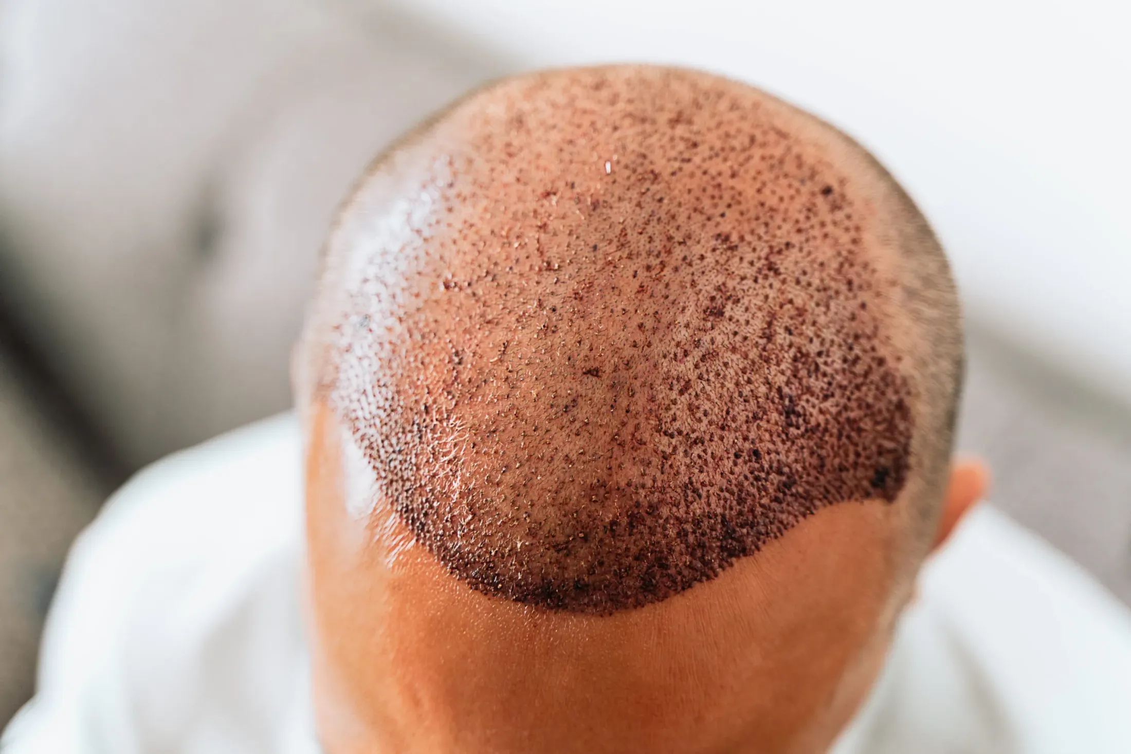 Cost of Hair Transplant in Kenya