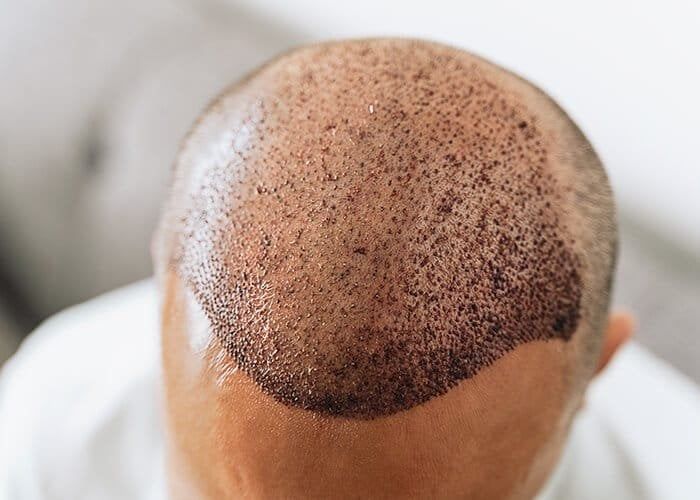 How Long Do Hair Transplants Last?