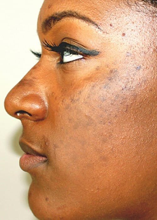 Laser Hyperpigmentation Treatment in Nairobi