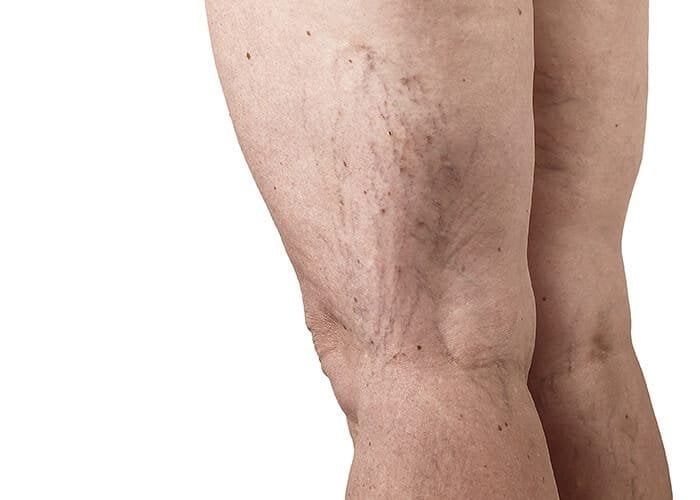 Laser Varicose Vein Treatment in Nairobi