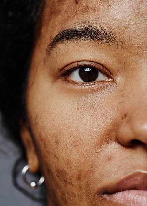 Myths about Acne