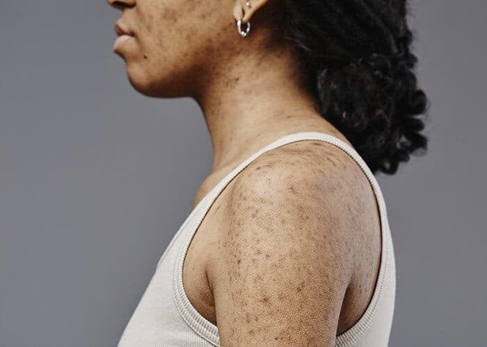 NarrowBand UVB Treatment in Nairobi