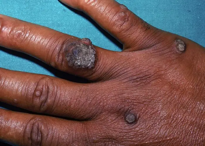 5 Common Myths of Warts that People Think are True & How They Are Treated