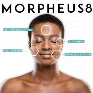 Morpheus8 treatment