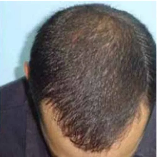 Hair Restoration Treatment in Nairobi