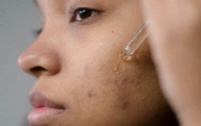 A Guide to Acne Solutions