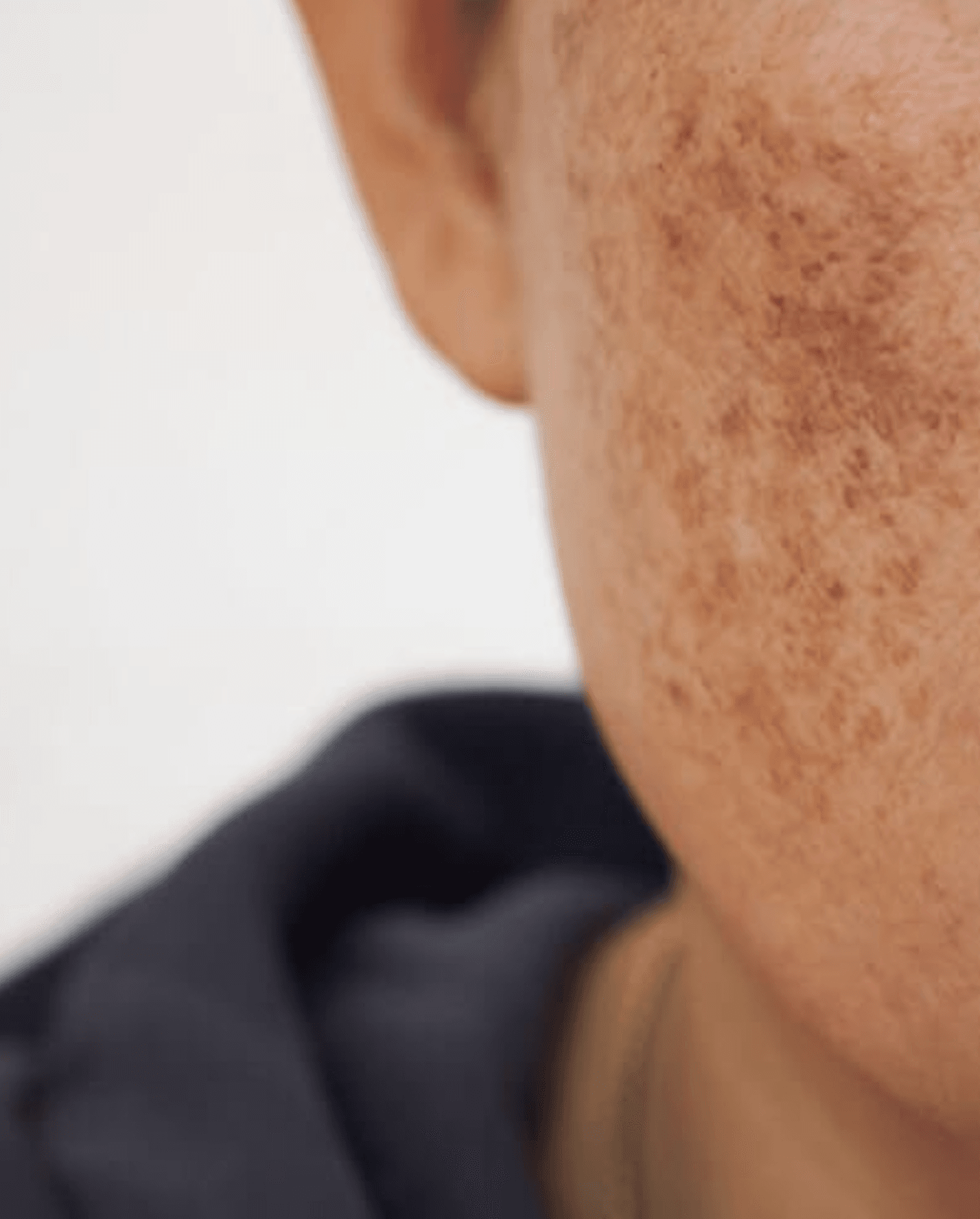 Acne treatment Avane Dermatology Clinic