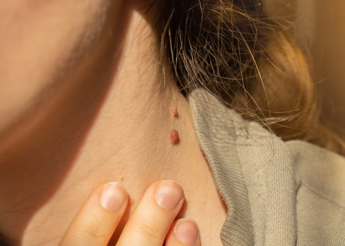 Understanding Mole Mapping: Your Guide to Skin Health