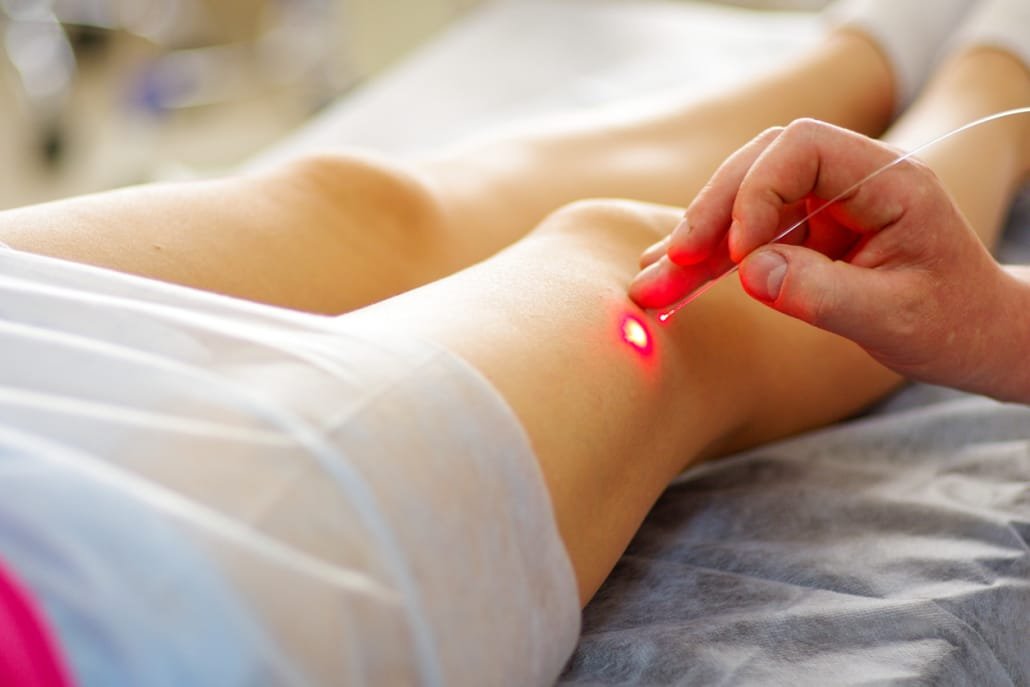 Varicose-Veins-Laser-Treatment at Avane Dermatology Clinic Nairobi Varicose-Veins-Laser-Treatment at Avane Dermatology Clinic Nairobi