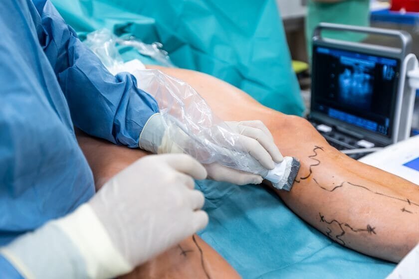 Varicose-Veins-Laser-Treatment at Avane Dermatology Clinic Varicose-Veins-Laser-Treatment at Avane Dermatology Clinic