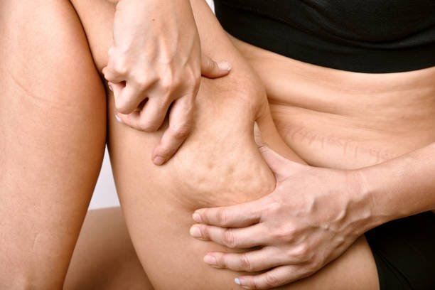 Cellulite Treatment in Nairobi, Kenya