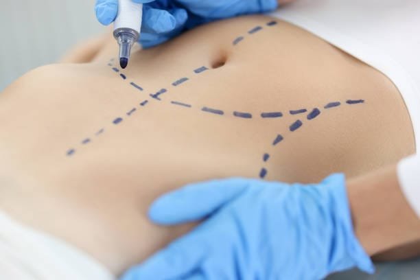 Liposuction In Nairobi