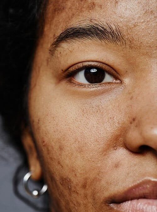 Myths about Acne