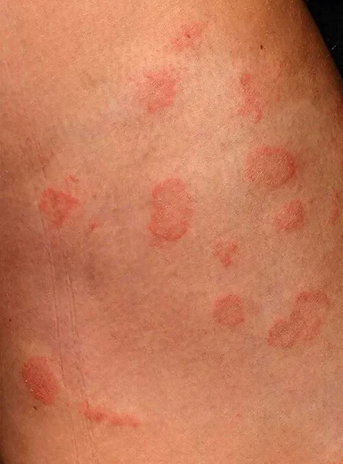 Skin Fungal Infection Treatment