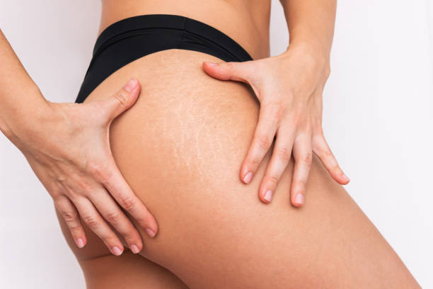 Can Microneedling Treat Old Stretch Marks?