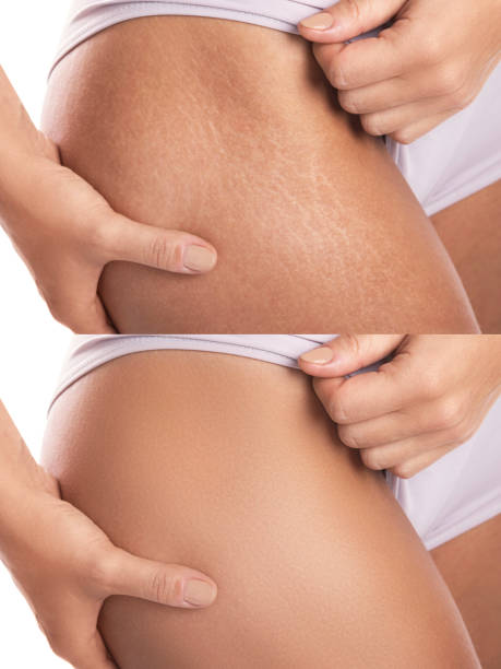 Can Microneedling Treat Old Stretch Marks?