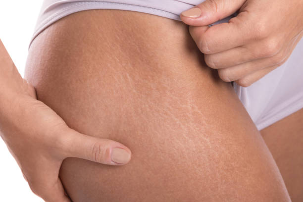 Can Microneedling Treat Old Stretch Marks?