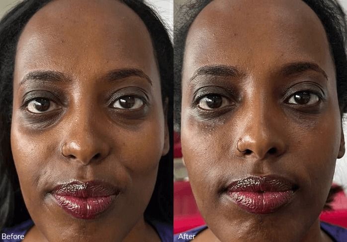 Before and after skin treatment comparison photo.