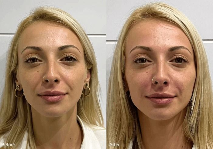 Before and after aesthetic treatment comparison.